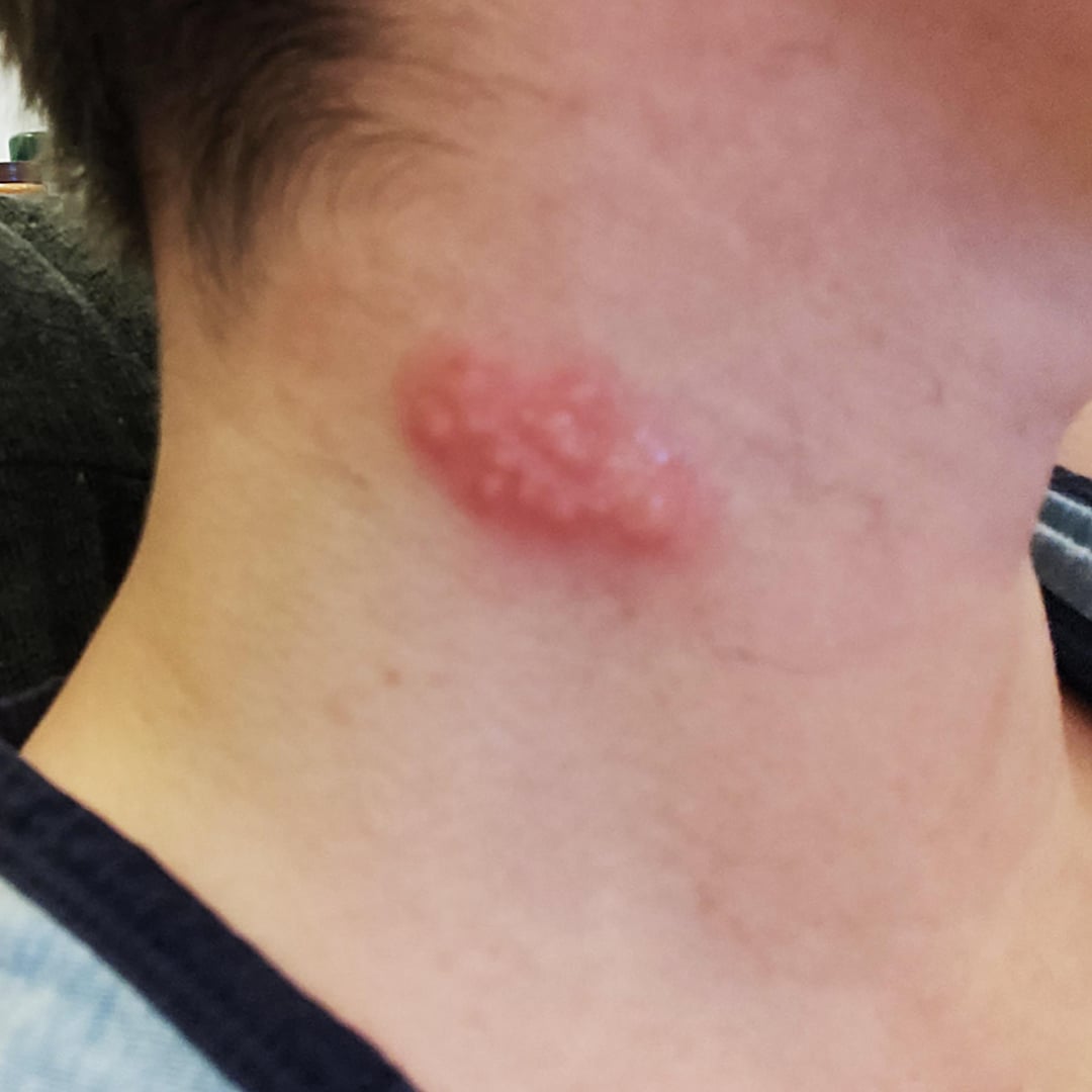 31-first-time-outbreak-on-neck-v0-uym0awpfjbic1